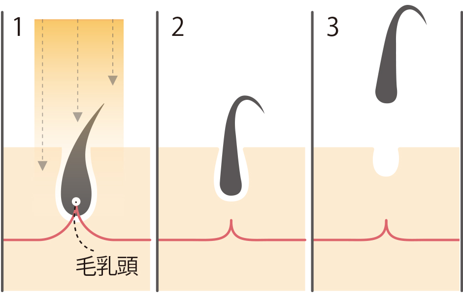 光脱毛のしくみ